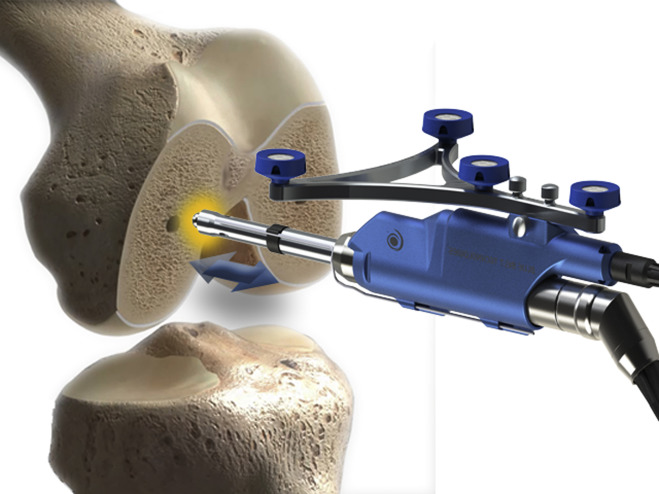 Robotic Knee Replacement  Total and Partial (Half)